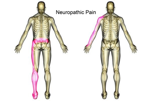 a human musculetal showing neuropathic pain.