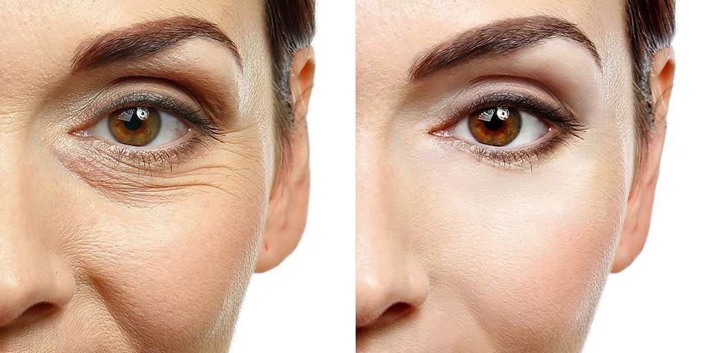 Eyelid Surgery for Wrinkles and Fine Lines